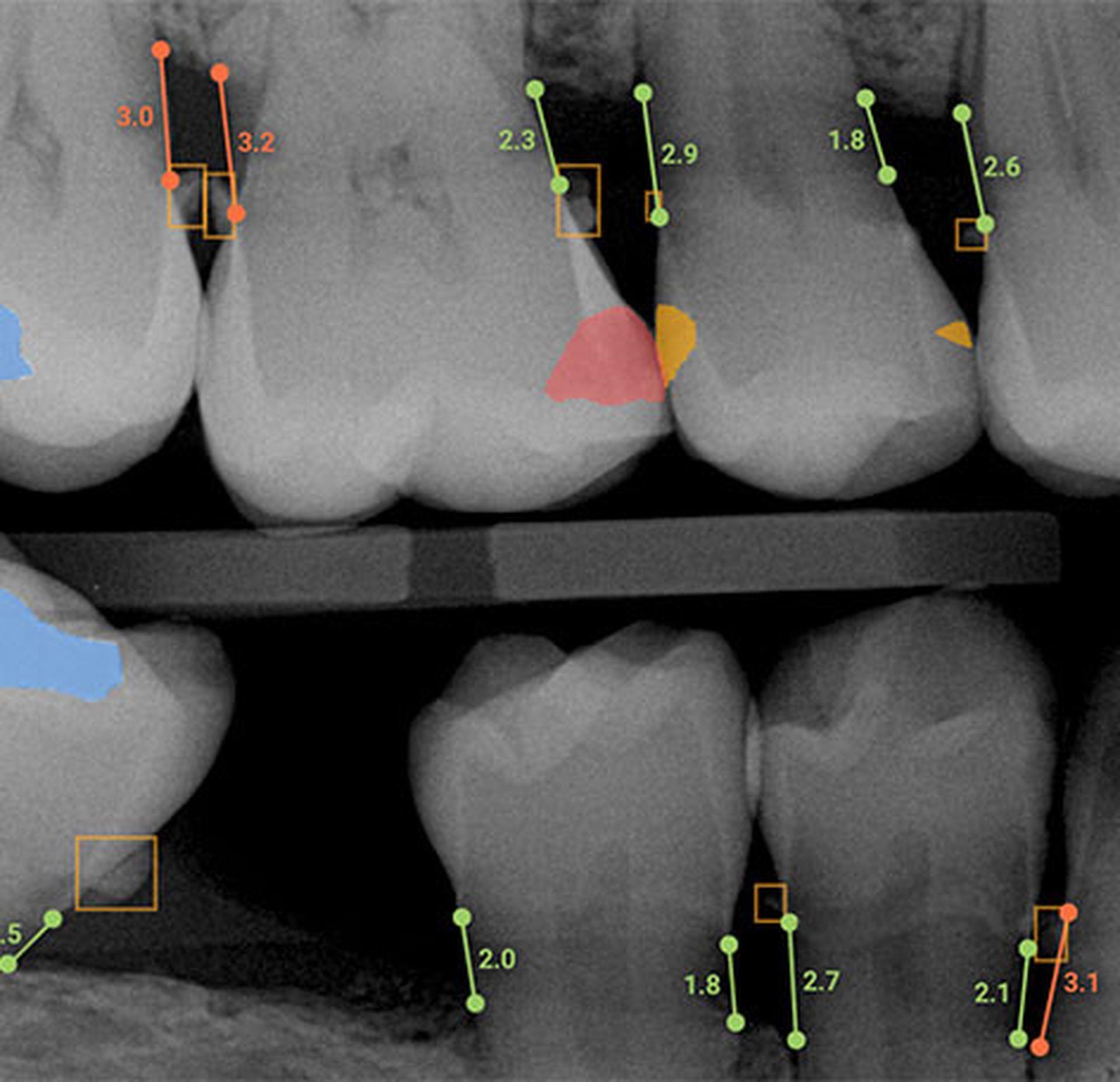 Overjet dental AI program's aim is to remove the guesswork out of the diagnosis process so every professional can offer the right treatment to their patients.